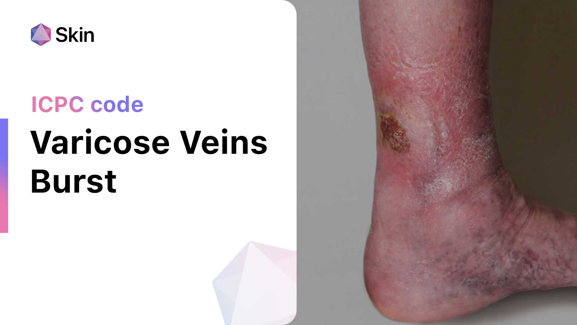 when-varicose-veins-burst-managing-ruptured-veins-and-bleeding