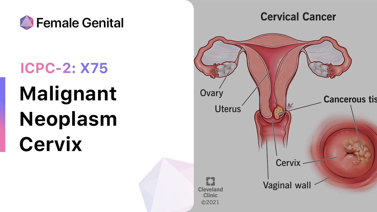 Malignant Neoplasm Cervix Icpc 2 X75 3341